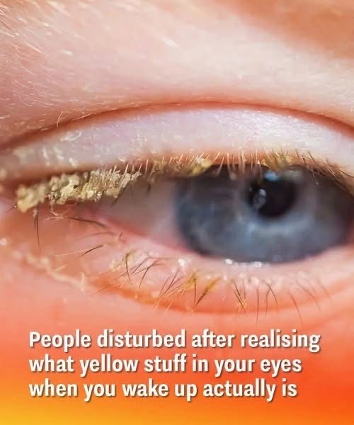 The Truth Behind the Yellow Crust in Your Eyes When You Wake Up