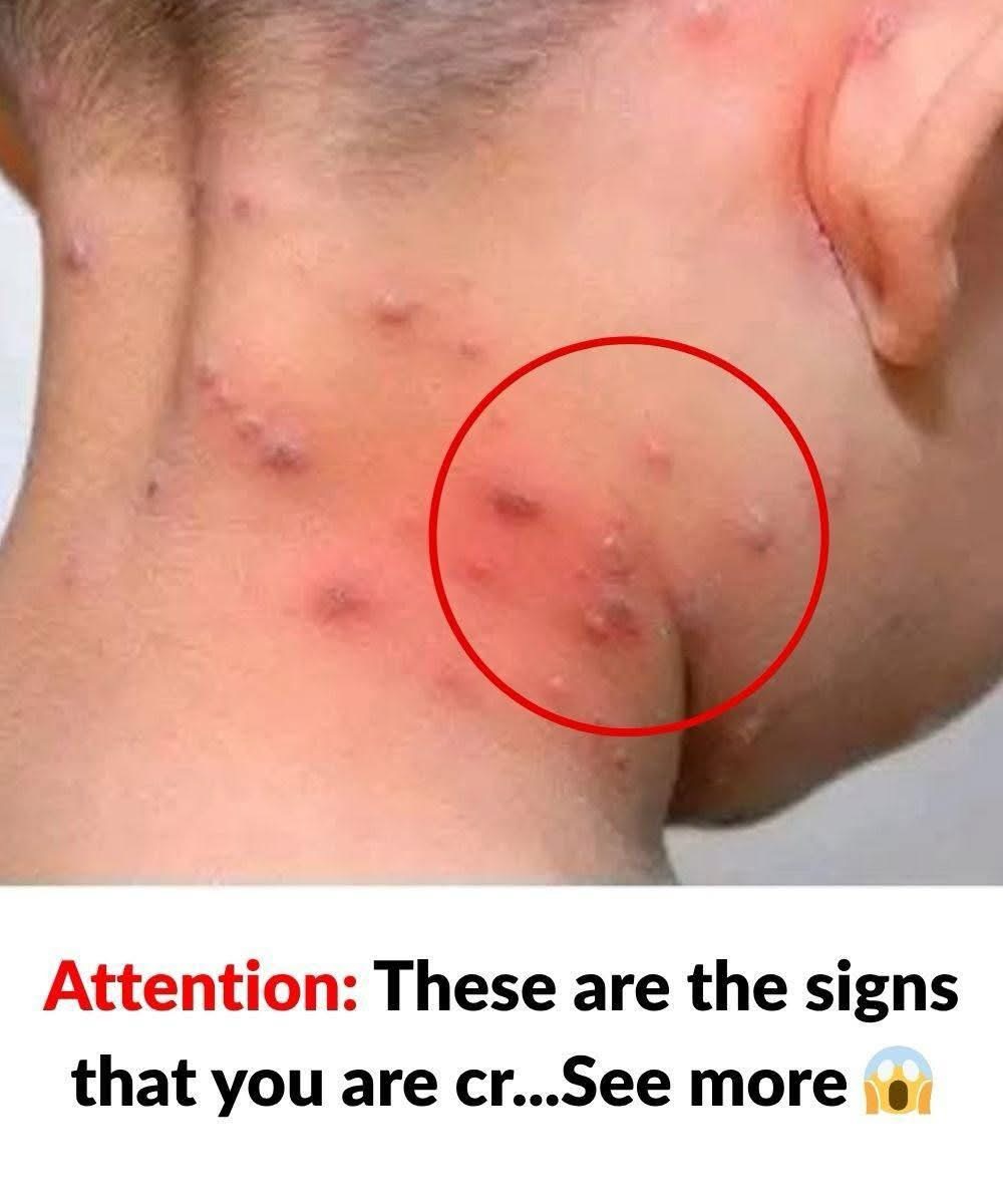 Attention: These Red Bumps on the Neck Could Be Warning Signs Your Body Is Trying to Tell You Something