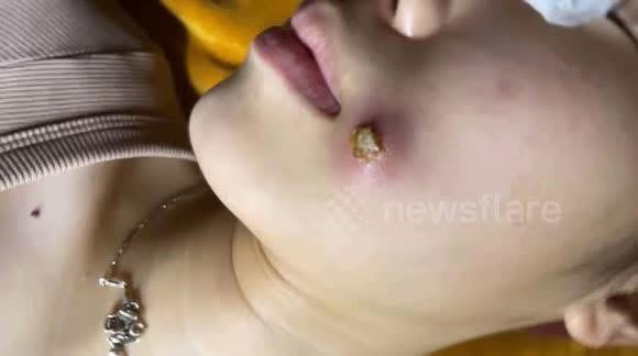 Why Pimples Grow So Large