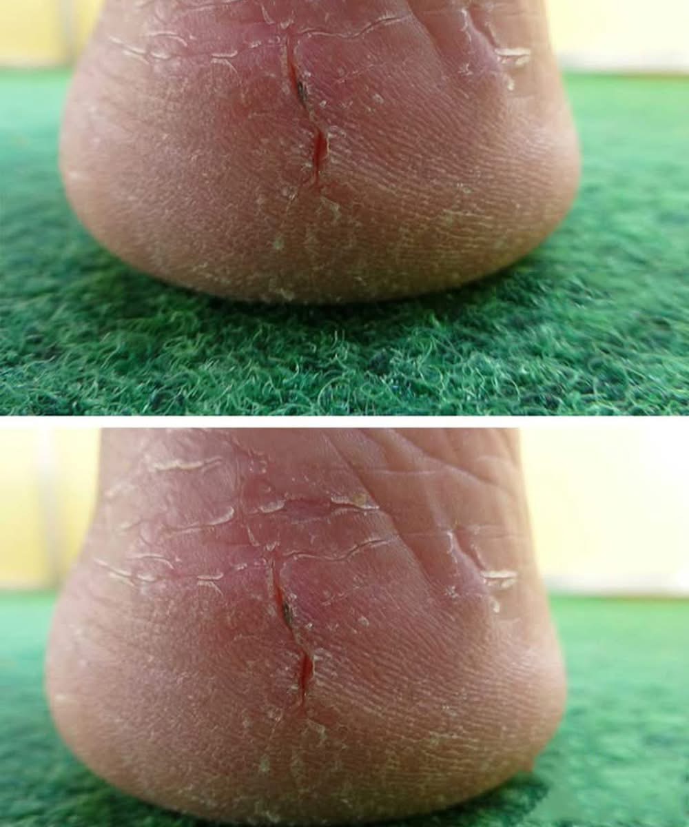 Cracked Heels That Won’t Heal? Here’s What You Need to Know Before It Gets Worse