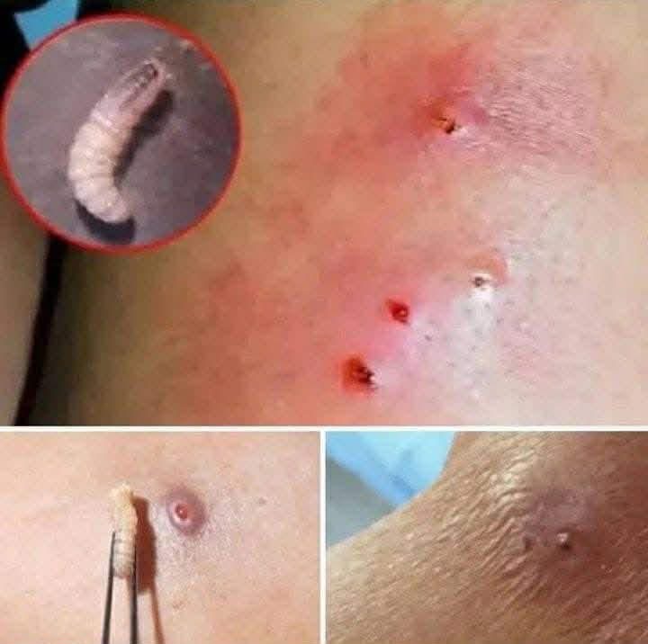 Larvae Found in Young Woma