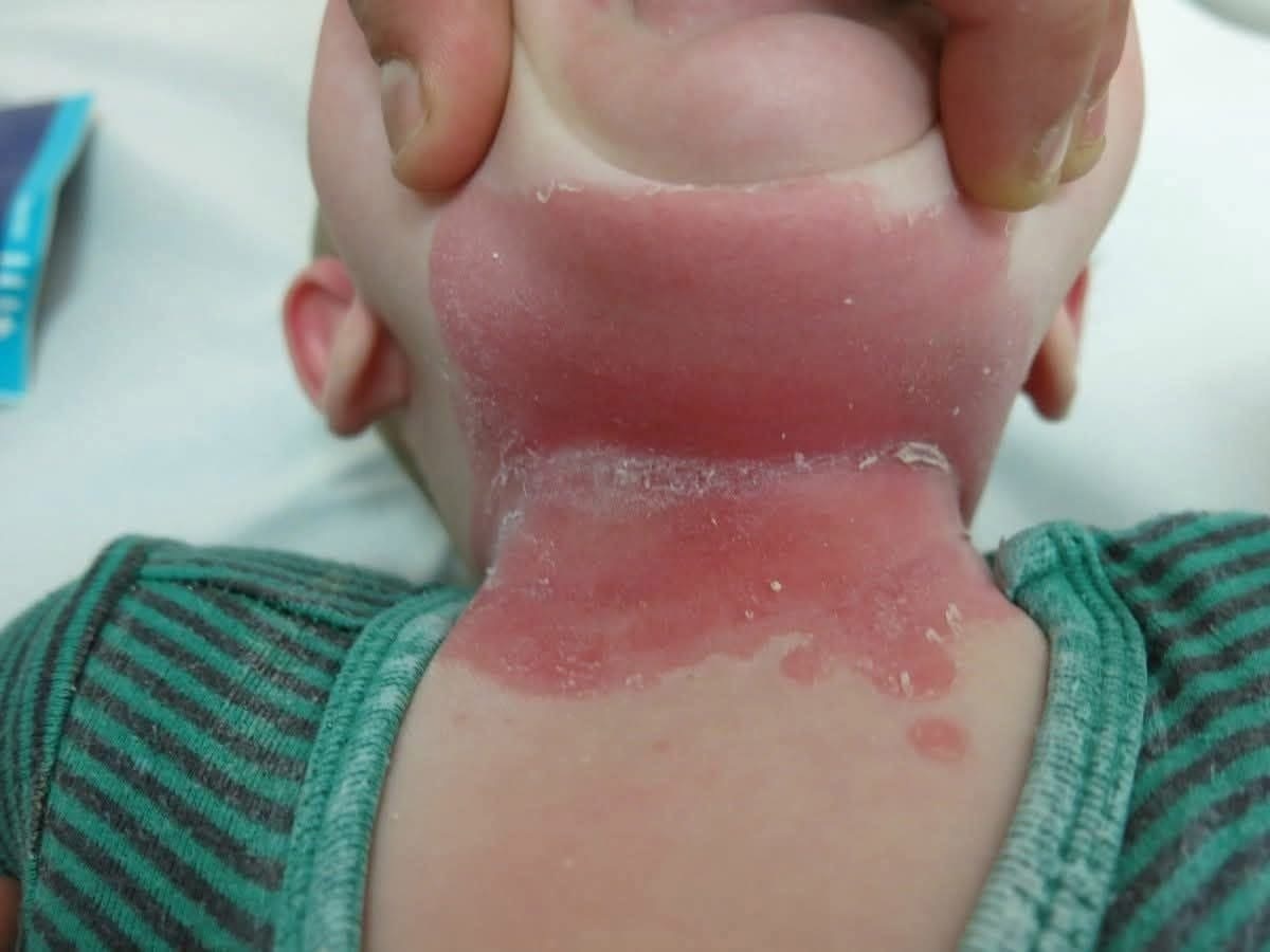 He Woke Up With a Red Patch on His Neck — Hours Later, Doctors Told His Parents Something They Never Expected