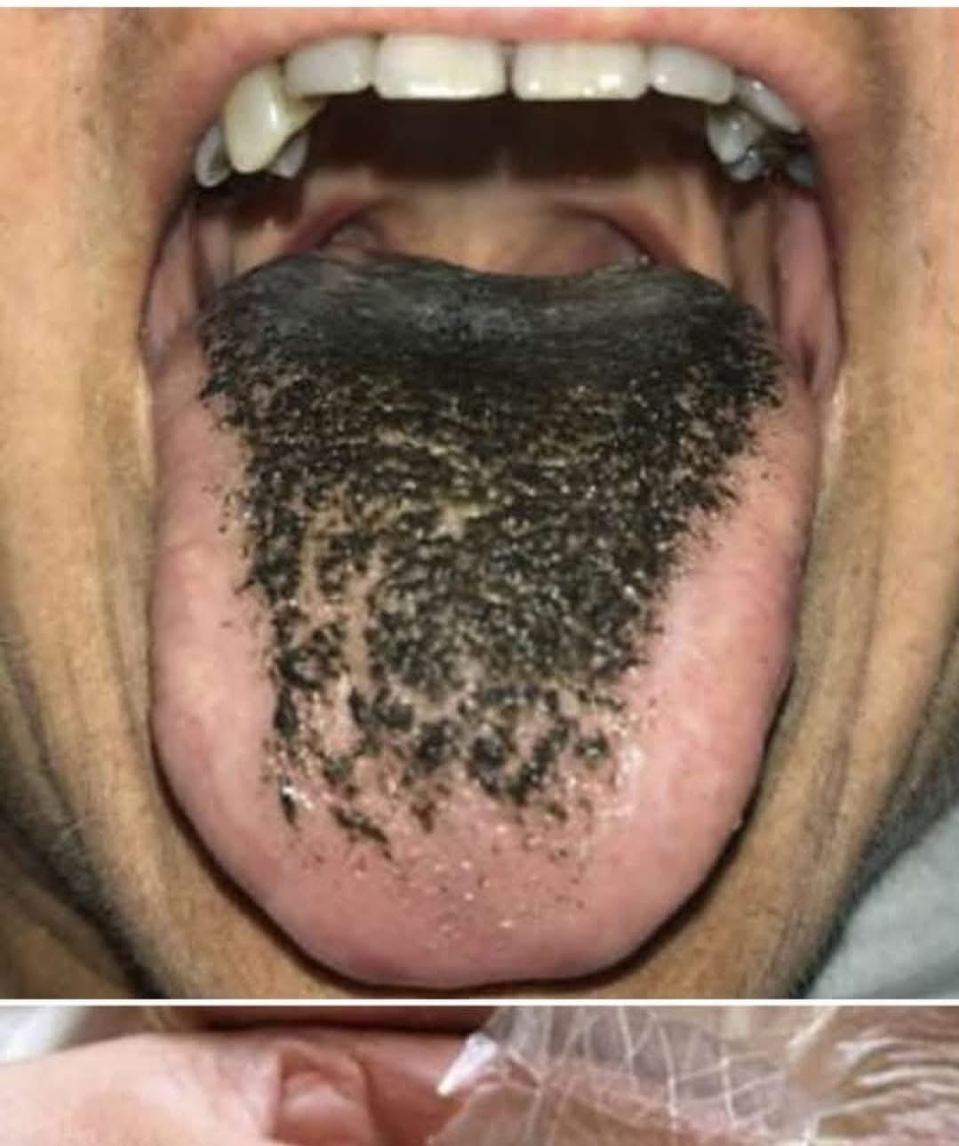The Shocking Reason His Tongue Turned Black Overnight