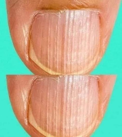 If Your Nails Look Like This, Your Body Might Be Sending a Warning You Shouldn’t Ignore