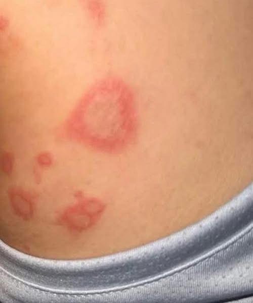 My 15 year old son been at his Nanny house for the weekend and he came back home with different sizes of bumps ..