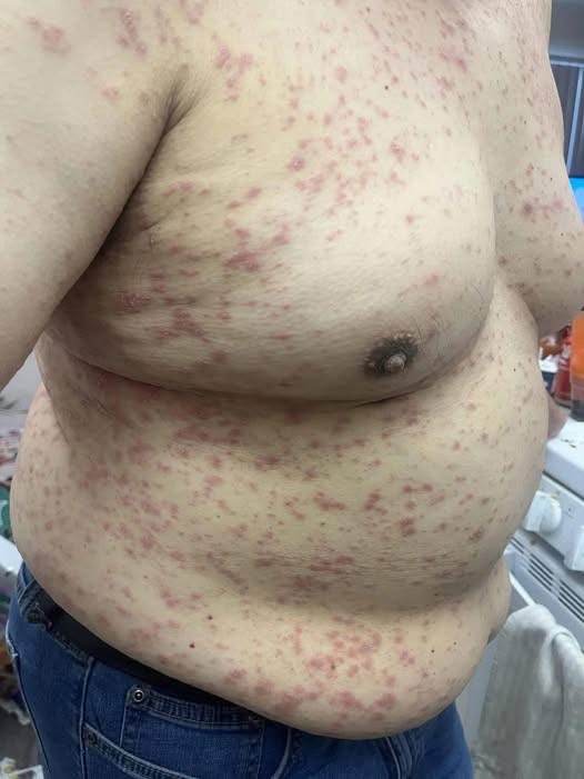 DOCTORS WARN: THIS FULL-BODY ITCHY RASH IN PEOPLE OVER 60 SHOULD NEVER BE IGNORED
