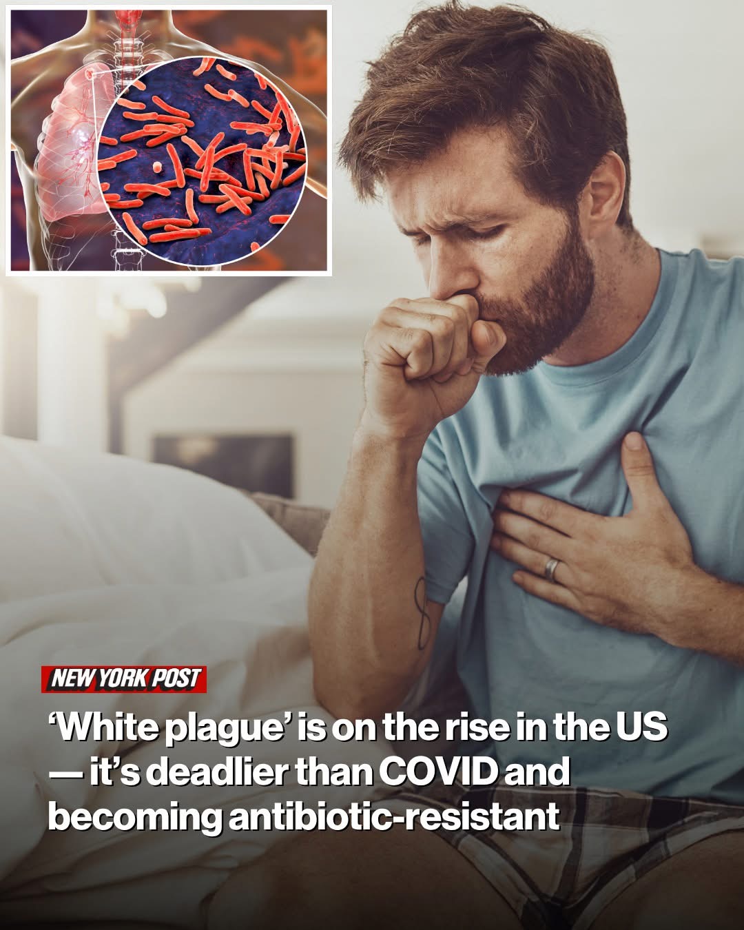 HEALTH ‘White plague’ is on the rise in the US — it’s deadlier than COVID and becoming antibiotic-resistant
